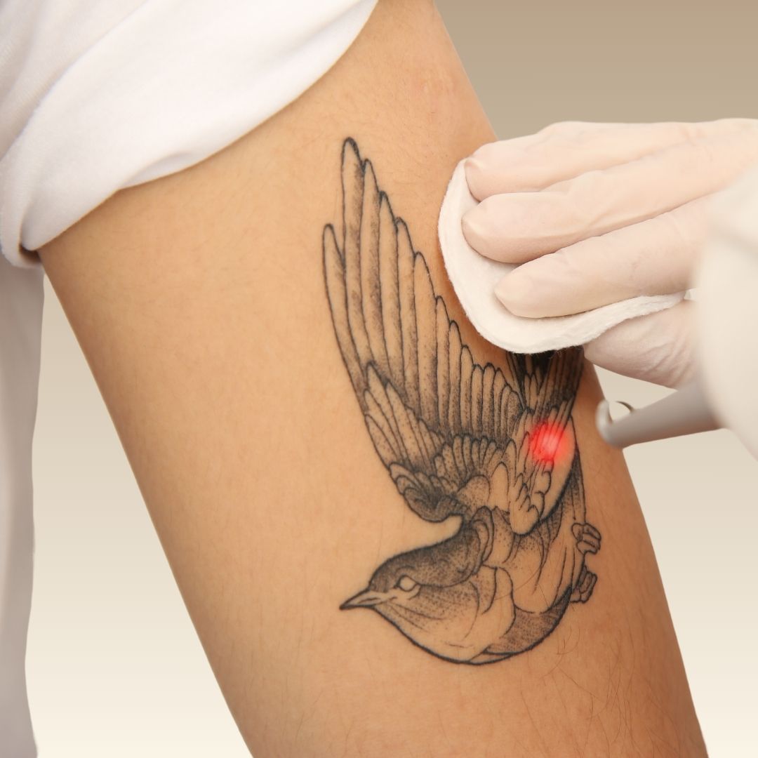 PICO TATTOO REMOVAL